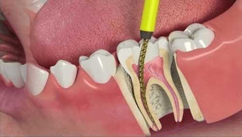 درد بعد از درمان ریشه دندان