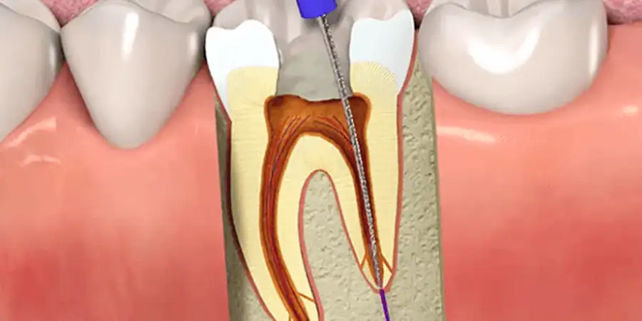 درمان ریشه دندان در کرج